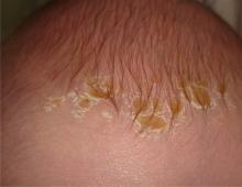 پوسته روی سر نوزاد، درمان کوماروفسکی