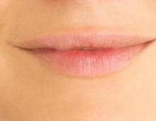 Complications après un tatouage sur les lèvres